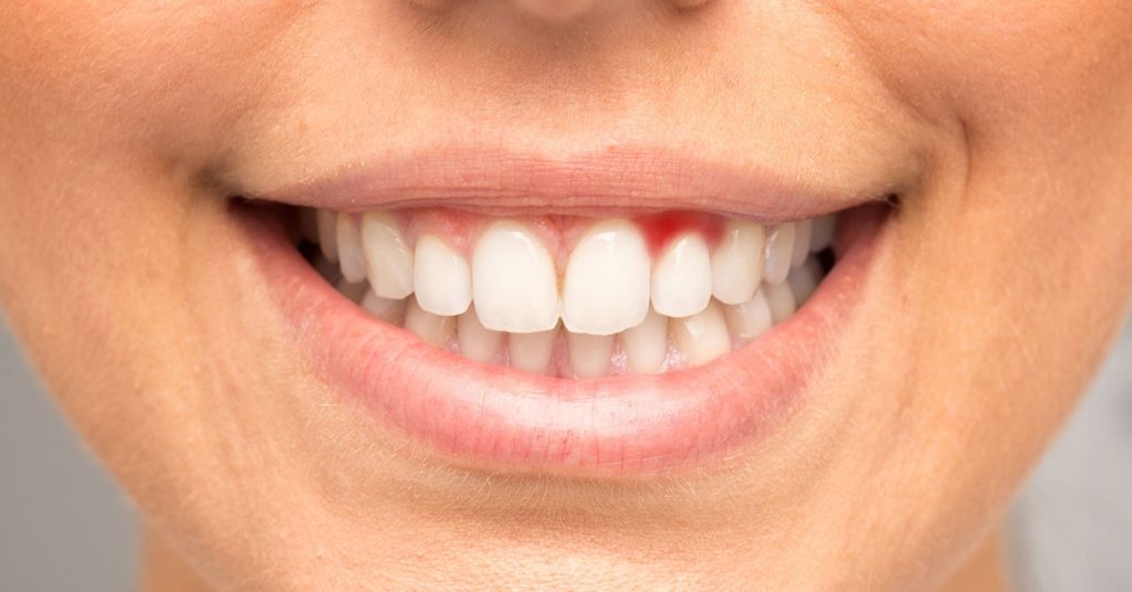 The For your information on Gum Disease