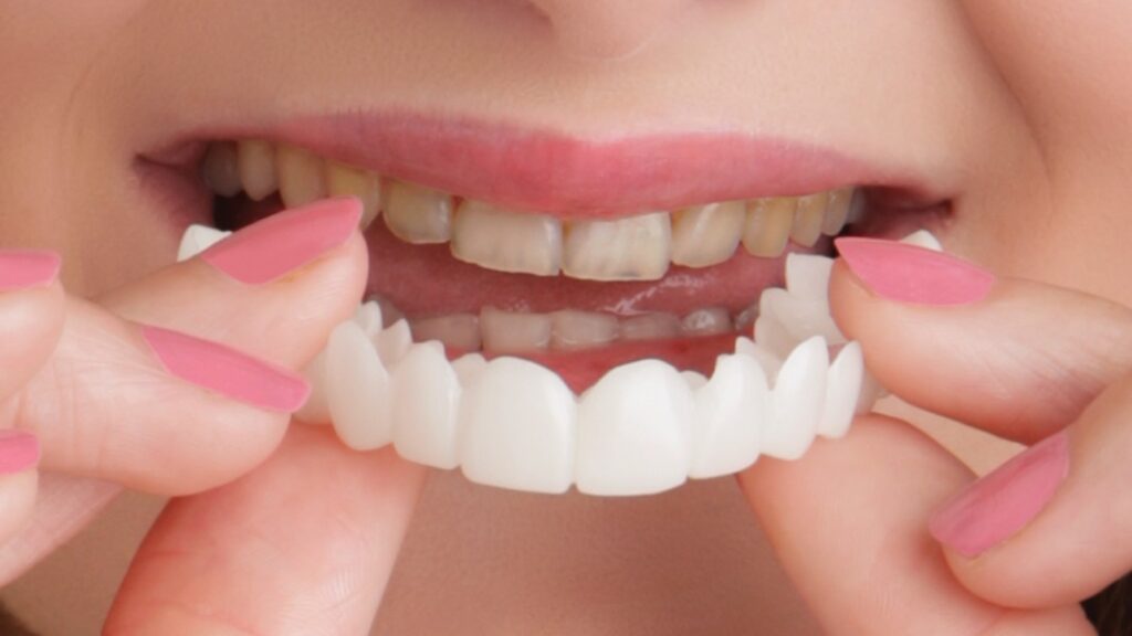 What all you need to know about snap on smile? Read on to know!